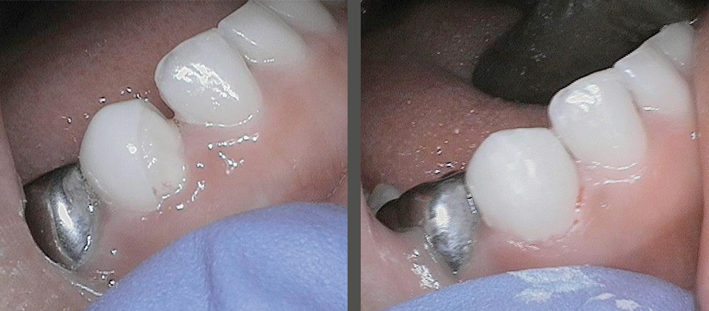 Restorative Options for a Fractured Zirconia Crown 1