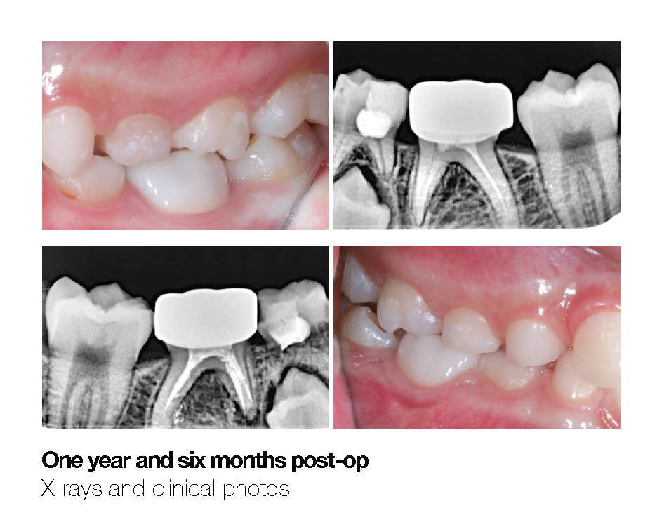 Making a Permanent Difference with Zirconia Crowns (5-Year Follow Up) 8