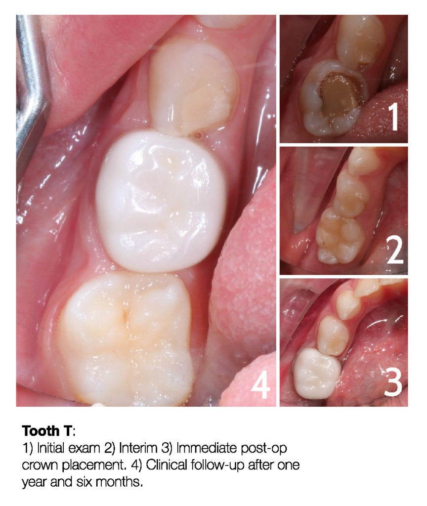 Making a Permanent Difference with Zirconia Crowns (5-Year Follow Up) 7