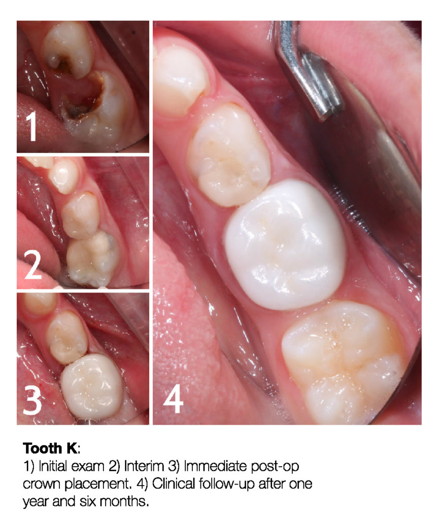 Making a Permanent Difference with Zirconia Crowns (5-Year Follow Up) 6