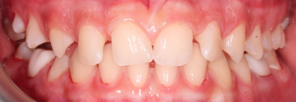 Making a Permanent Difference with Zirconia Crowns (5-Year Follow Up) 9