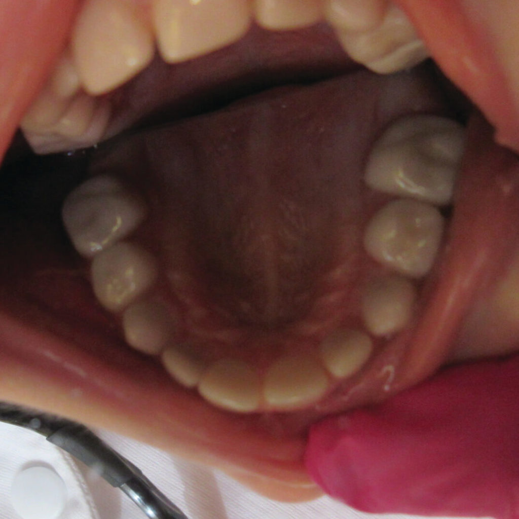 From Dentinogenesis Imperfecta to Zirconia Crown Perfection! 5