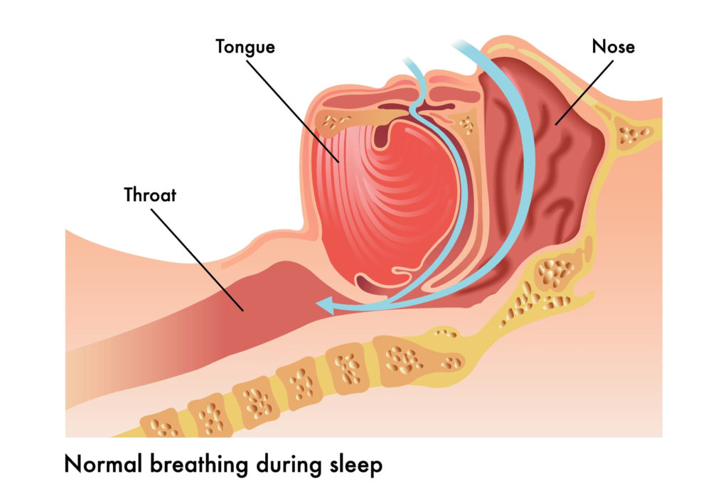 Obstructive Sleep Apnea in Pediatric Patients 3
