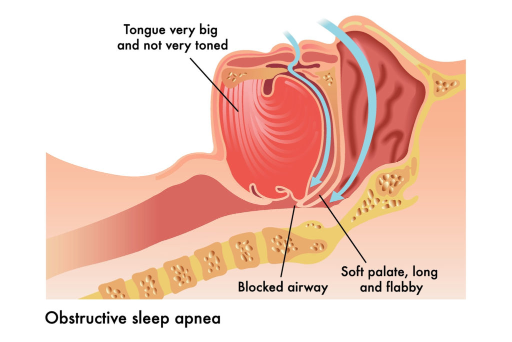 Obstructive Sleep Apnea in Pediatric Patients 4