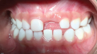 Dallas Duo Completes the First Full – Mouth Zirconia Crown Case 3