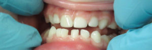 Treating Class 3 Malocclusions with Zirconia Crowns 5
