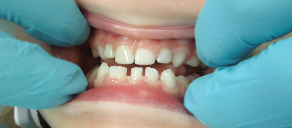 Treating Class 3 Malocclusions with Zirconia Crowns 1